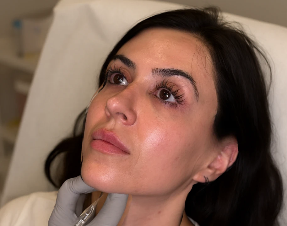 Before and after comparison of a Kybella treatment at Liv Aesthetics LLC in Thornwood, NY. The transformation highlights reduced fullness under the chin, resulting in a more contoured and defined jawline.