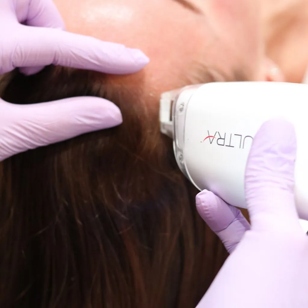 Image of a Keralase hair restoration treatment at Liv Aesthetics LLC in Thornwood, NY. A practitioner applies a device to the client’s scalp, showcasing a non-invasive method aimed at stimulating hair growth and improving scalp health.